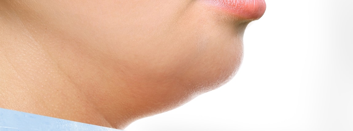 Cryolipolyse